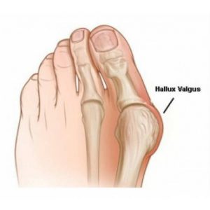 Ayak Bunyon Koruyucu Kemik Koruyucu